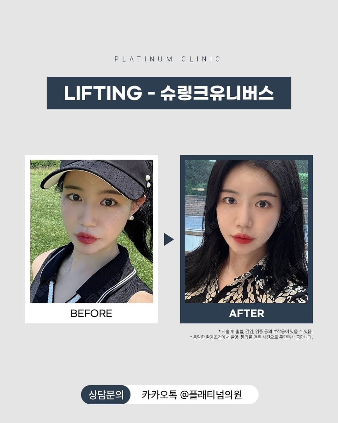 HIFU リフティング2回目の結果