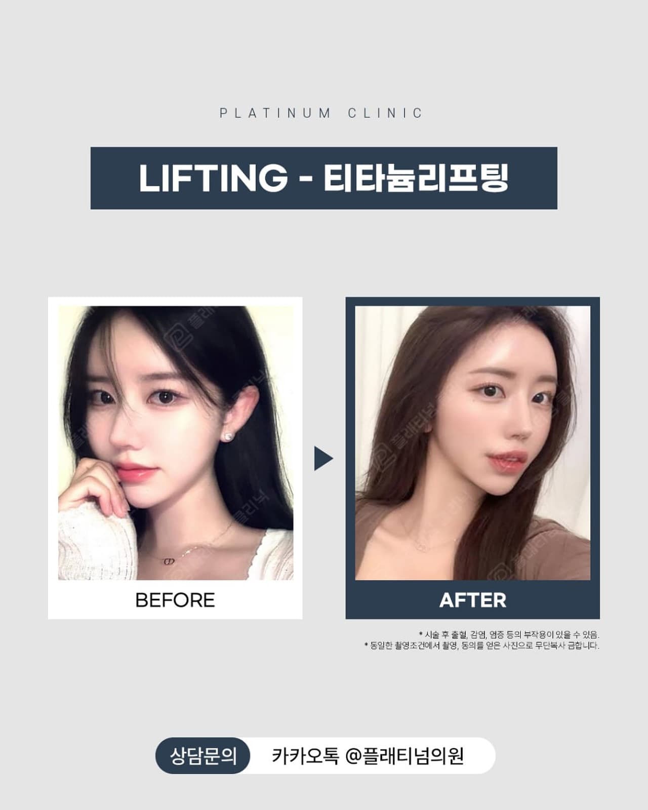 チタニウムリフティング8日目 ビフォーアフター