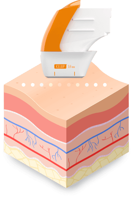 도트 타입 — SMAS층 작용