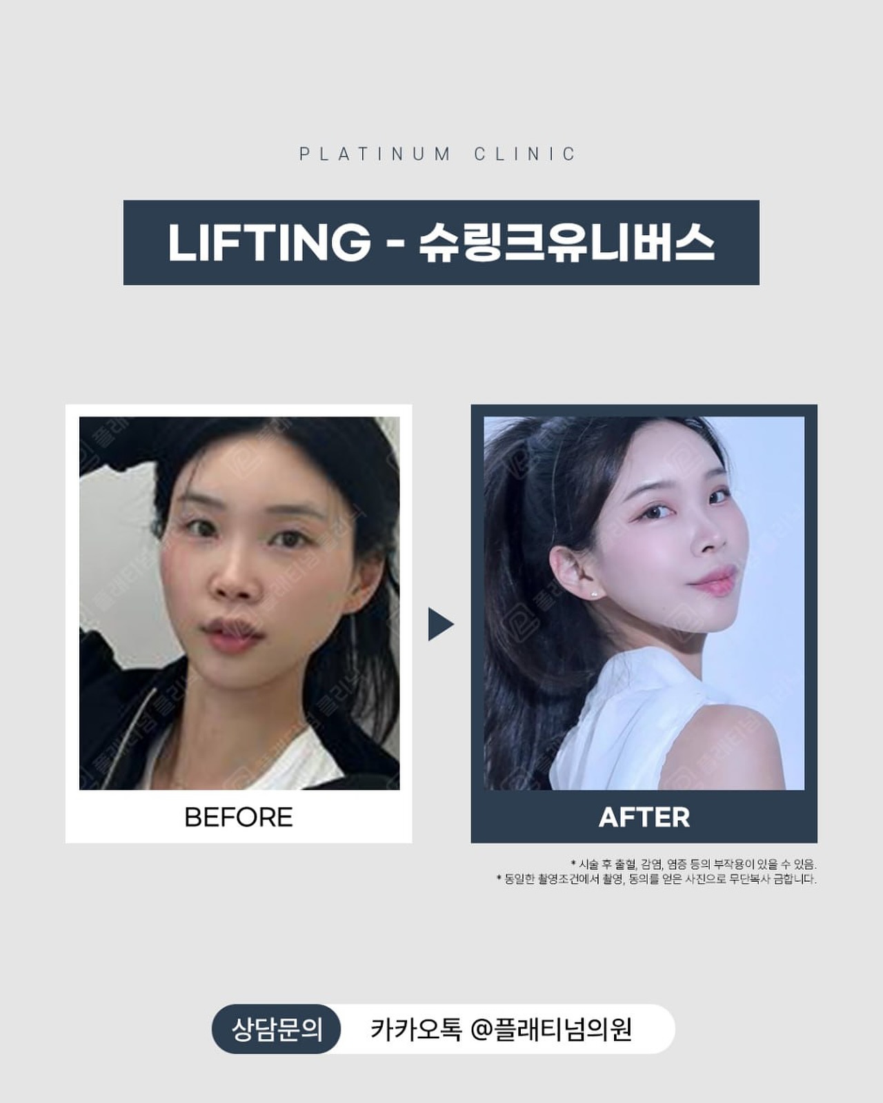 Shrink提升前後對比