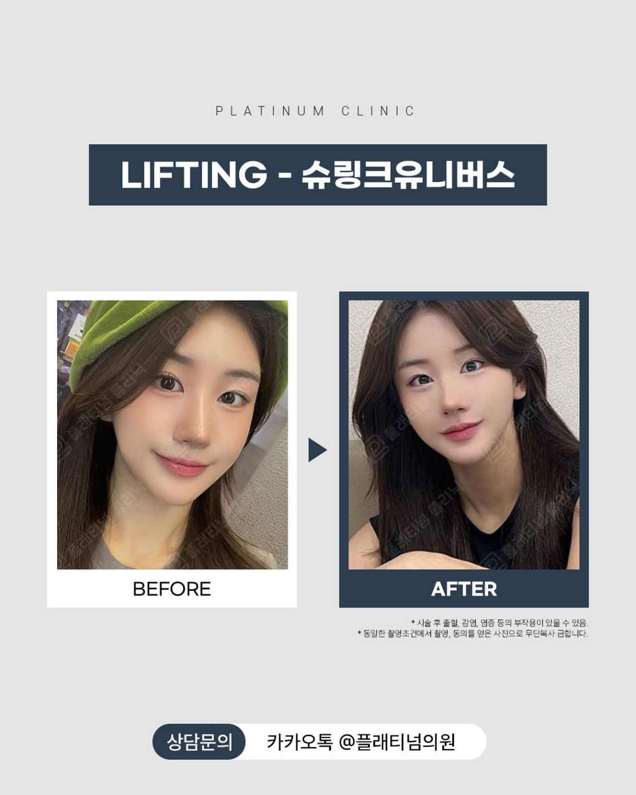 HIFU提升真實测評