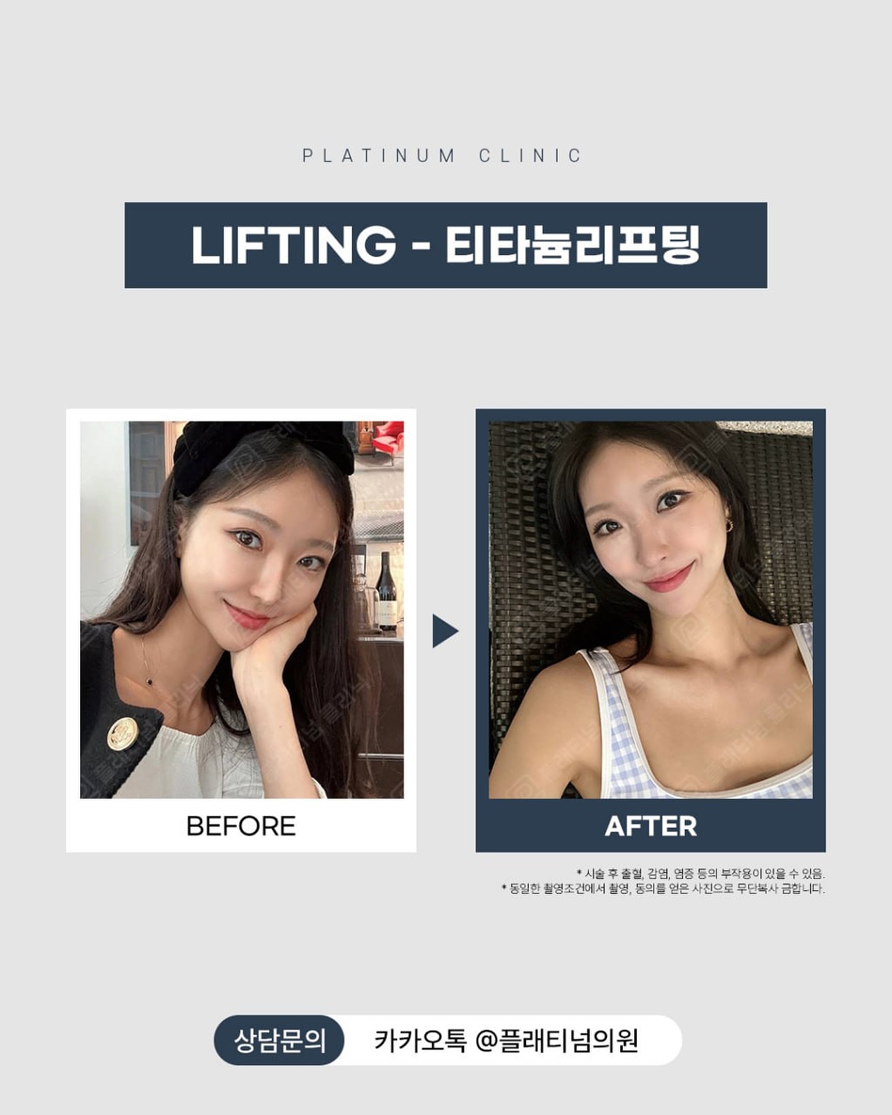 鈦提升第3次效果