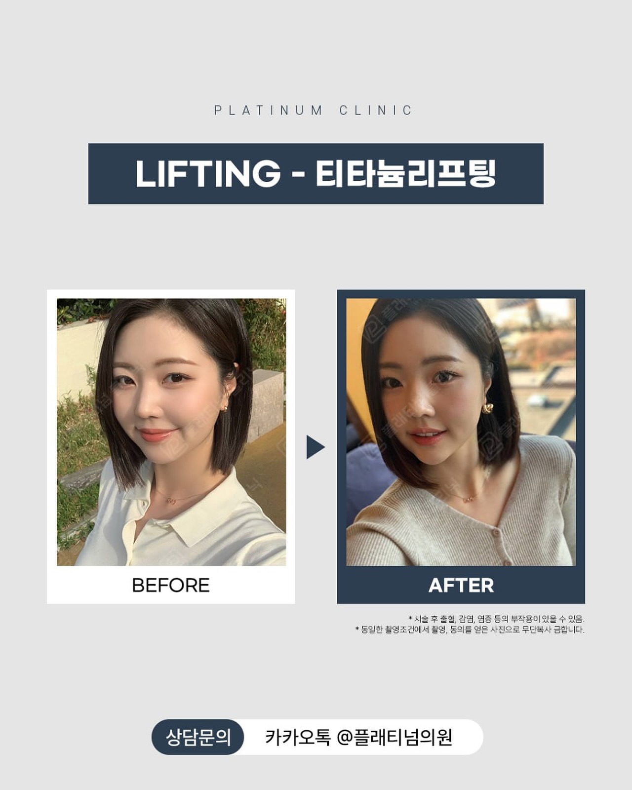 無恢復期提升前後